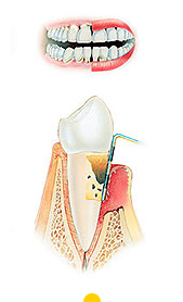 tratar periodontitis severa en Donostia